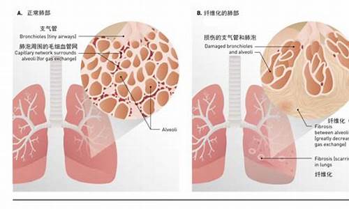悦刻电子烟会肺部纤维化吗